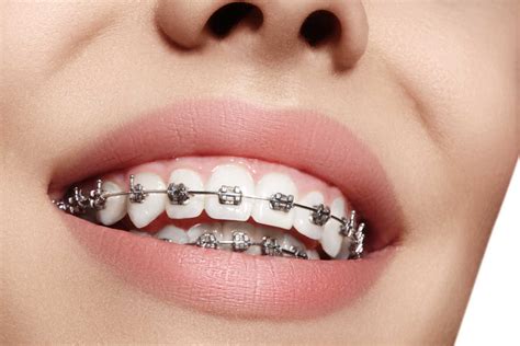 metal brackets en español|Metal brackets .